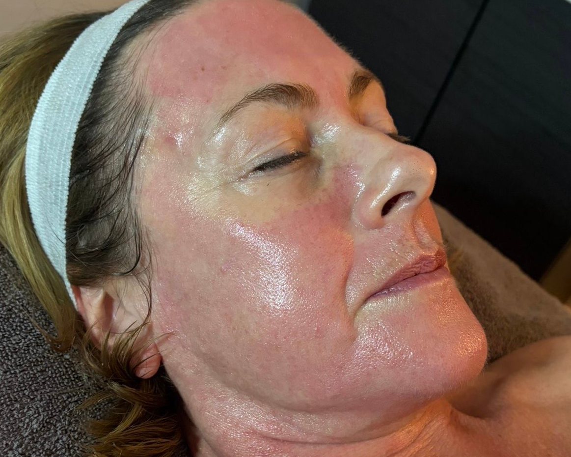Before microneedling treatment