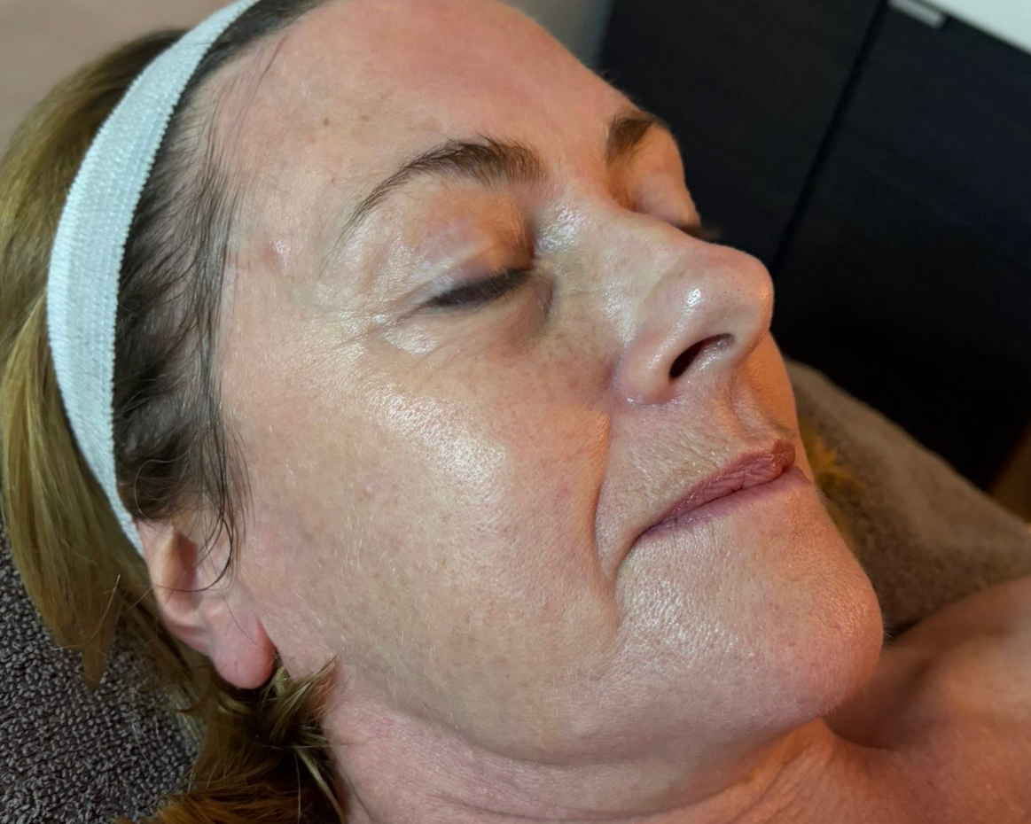 After microneedling treatment